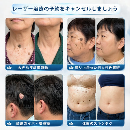 💧💧💧公式ストア🎉PuraCure® 7日間スポット＆シミ除去ケア （ゼロ痛み・ゼロダメージ ローラーボール）