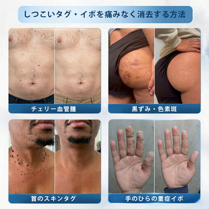 💧💧💧公式ストア🎉PuraCure® 7日間スポット＆シミ除去ケア （ゼロ痛み・ゼロダメージ ローラーボール）