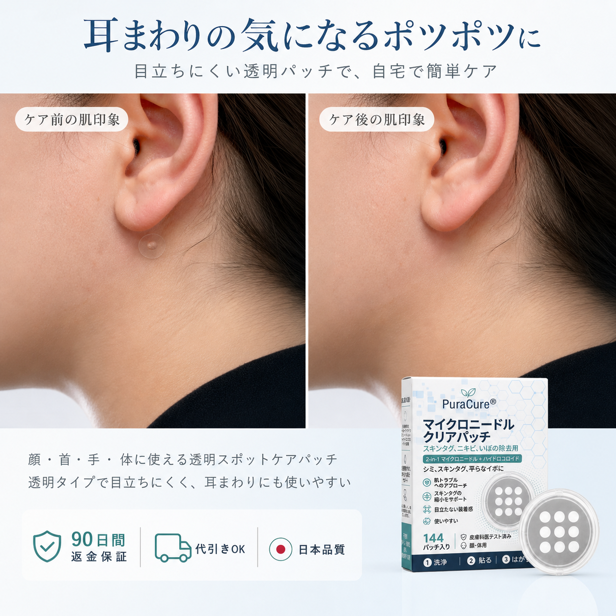 🌼PuraCure® 2-in-1 マイクロニードル＆ハイドロコロイドパッチ🍀| 盛り上がったホクロ・ニキビ・扁平イボ・スキンタッグのケアに | シワ・ニキビ跡・肌の色ムラをケア | 目立たない透明パッチ（顔・体用）