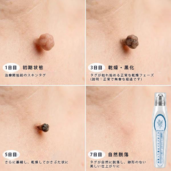 💧💧💧公式ストア🎉PuraCure® 7日間スポット＆シミ除去ケア （ゼロ痛み・ゼロダメージ ローラーボール）