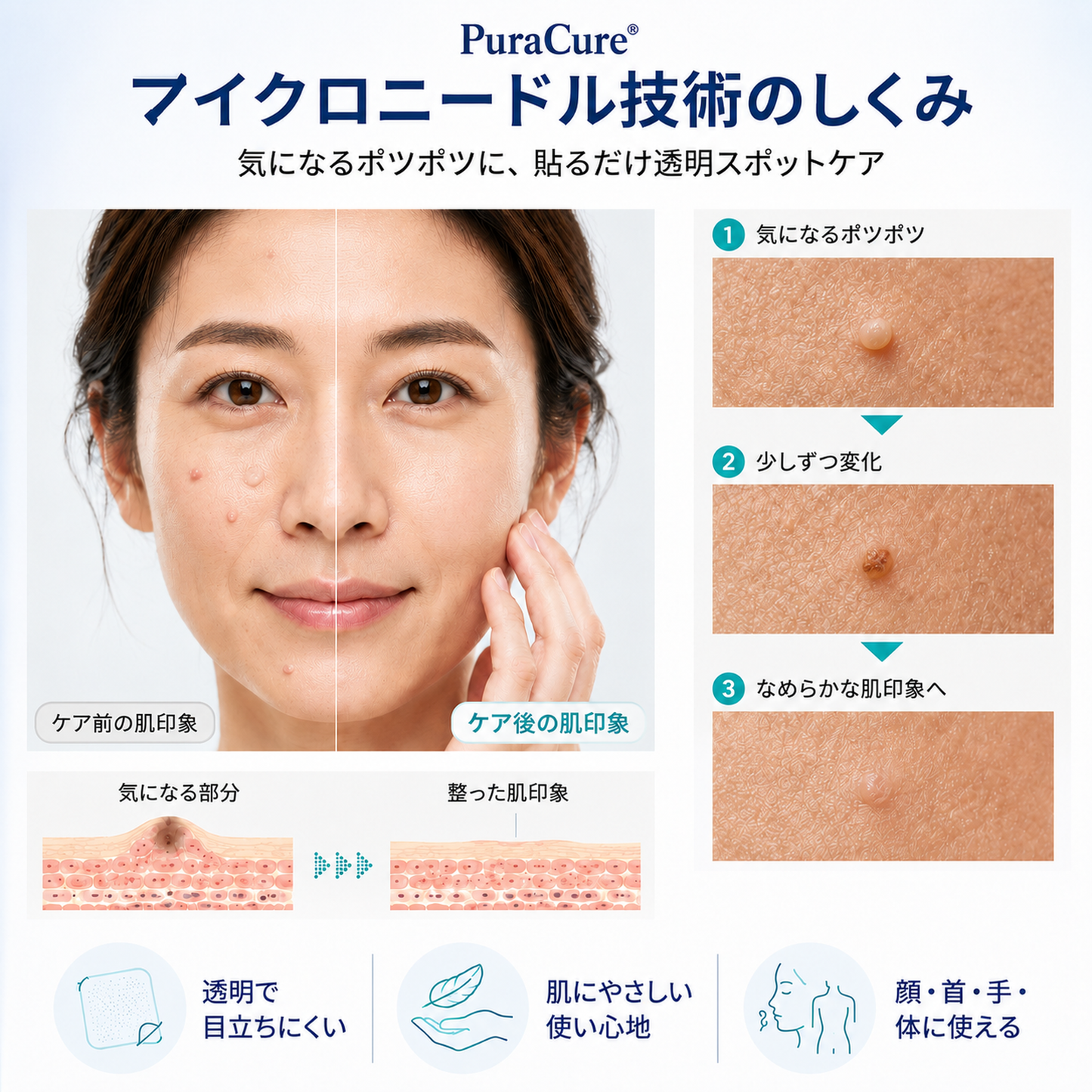 🌼PuraCure® 2-in-1 マイクロニードル＆ハイドロコロイドパッチ🍀| 盛り上がったホクロ・ニキビ・扁平イボ・スキンタッグのケアに | シワ・ニキビ跡・肌の色ムラをケア | 目立たない透明パッチ（顔・体用）